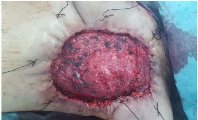 Figure 04 : Image du post opératoire immédiat, après réalisation de sutures de bouses  autour de la perte de substance