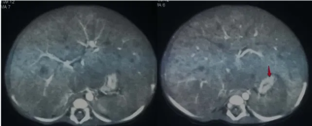 Figure n°41 : Hépatomégalie nodulaire hétérogène chez une fille de 2 mois révélatrice d’un  neuroblastome métastatique (flèche) : Syndrome de Pepper