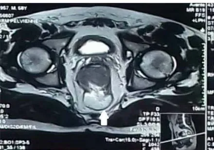 Figure 6: IRM objectivant un processus tumoral du moyen rectum sans extension locorégionale  chez un de nos malades 