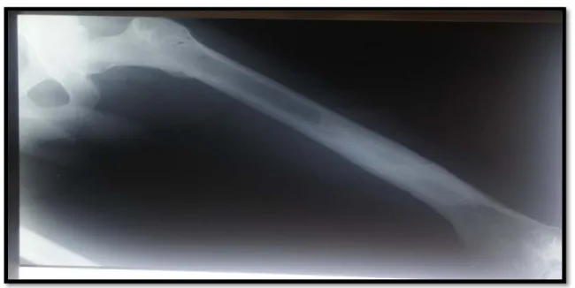 Figure 18 : lyse osseuse diaphyso-métaphysaire avec condensation et réaction périostée        (photo du service)