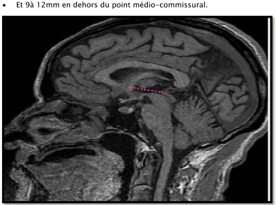 Figure 7 : Repérage de la ligne bicommissurale sur IRM cérébrale coupe axiale T1.  Sur la coupe coronale T2 