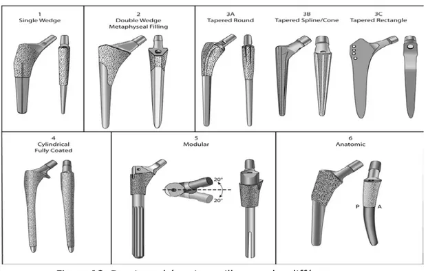 Figure 12: Dessins schématiques illustrant les différents types   des implants fémoraux non cimentés [8] 