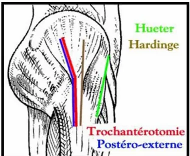 Figure 15 : Le tracé de l’incision cutanée des différents voies d’abord de la hanche [13] 