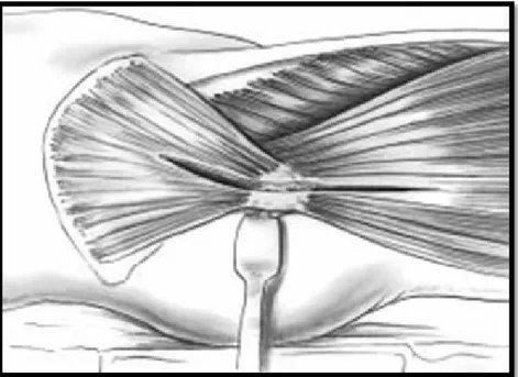 Figure 17: Incision musculo tendineuse transglutéale  [18] 