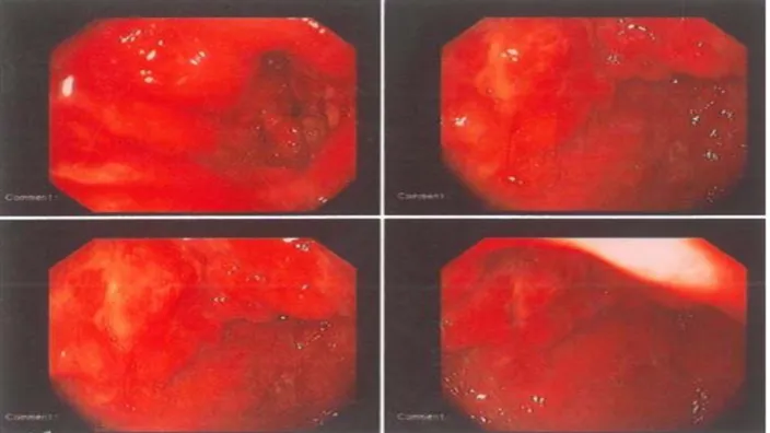 Figure 10 : Présence d’un processus tumoral de la région antrale envahissant le pylore (notre série)   