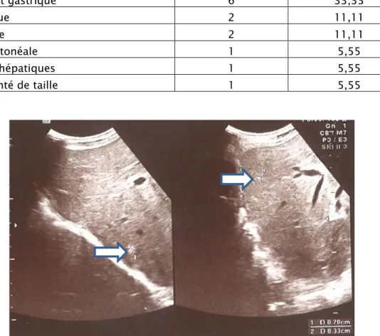 Tableau IX : Résultat de l’échographie abdominale 