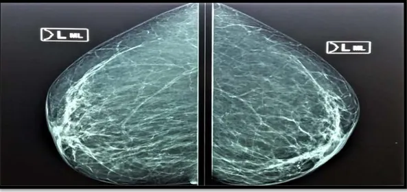 Figure 14  :  image mammographique montrant des  calcifications annulaires et en  bâtonnet prédominants en retro-aréolaire 