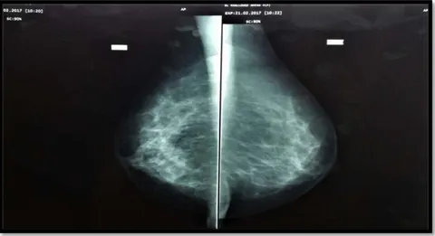 Figure 16  :   image mammographique de microcalcifications en foyers au niveau du  quadrant supéro-externe du sein gauche (ACR=4) avec sein droit normal .
