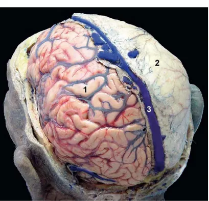 Figure 7: Cerveau d’une pièce anatomique cadavérique, vue postéro-latérale gauche, sans (1) et  avec (2) sa dure-mère