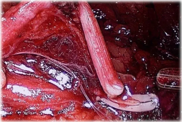 Figure 13 : section de l’uretère après mise en place du clip Hem-O-Lock  Après la néphrolyse complète, le rein se trouve fixé que par son pédicule