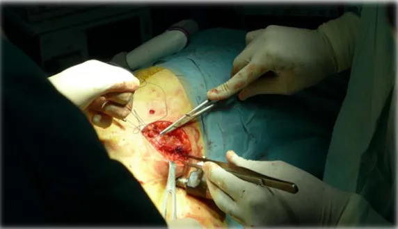 Figure 18 : Fermeture de l’incision d’extraction du greffon 