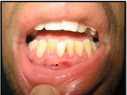 Figure 20 : photographie d’un patient : muqueuse congestive en regard de la dent  causale