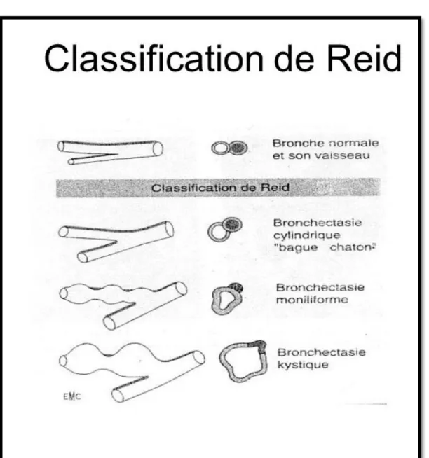 Figure 1 : Classification des DDB selon REID [2,3] 