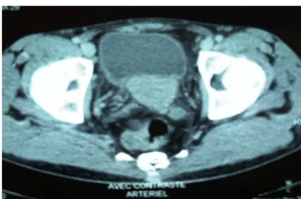 Figure 8 :tumeur vésical bourgeonnante infiltrant la graisse intervésico-séminale et prostate  Une urographie intraveineuse (UIV) a été effectuée chez 3  (14,28%) patients
