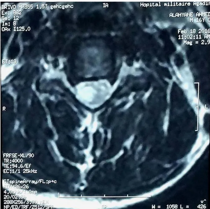 Figure 2: IRM Cervicale, coupe axiale en séquence pondérée T2 montrant un processus  intramédullaire en hypersignal latéralisée à droite