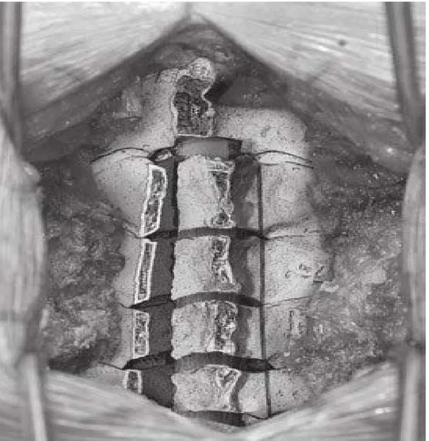 Figure 21 : Ablation du cortex externe seulement sur le côté controlatéral (côté porte fermée) et  fracture sur ce côté fermé