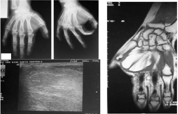 Figure 25 : aspect radiologique de Lipome de la main A : Radiographie simple de la main en incidence de face
