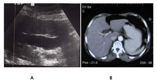 Figure  2 : A : Echographie hépato-biliaire objectivant une dilatation de la VBP. 