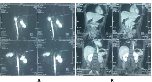 Figure 5 (A, B) : Des coupes de bili-IRM objectivant une dilatation des VBIH et de la VBP type IVa  de Todani