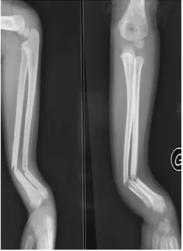 Figure 25 : Radiographie de l'avant bras d'un enfant âgé de 10 ans face et profil objectivant une  fracture déplacée des  2 os de l’avant bras avec déplacement en angulation 35°  radiale et ulnaire 