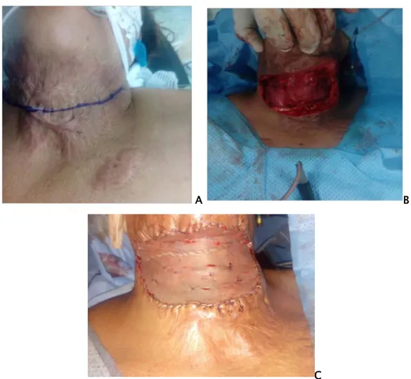 Figure 30 : bride cervicale traitée par excision-greffe de peau totale 