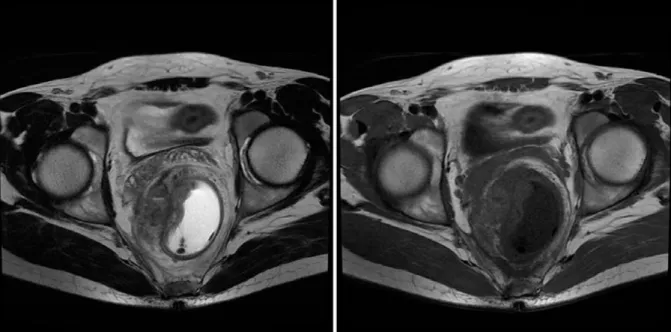 Figure 6 : IRM pelvienne montrant un cancer du bas rectum chez un patient de notre étude 