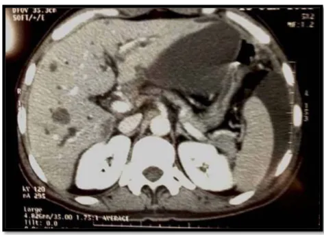 Figure 9 : Coupe scannographique axiale de l’abdomen après injection de produit de contraste  montrant des MH chez un patient de notre étude