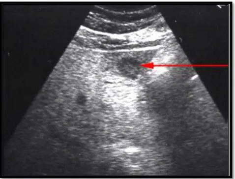 Figure 11 : Image échographique en cocarde d’une MH d’un cancer du bas rectum chez un  patient de notre étude 