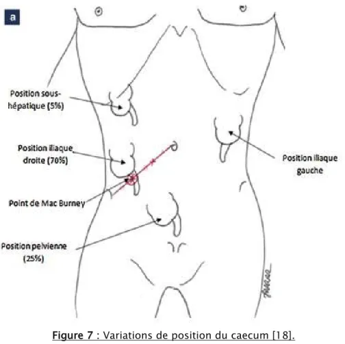 Figure 7 : Variations de position du caecum [18]. 