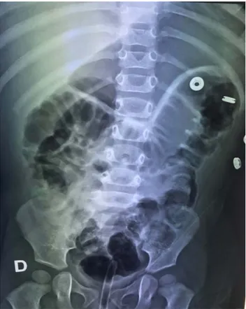 Figure 14 : Insufflation d'air (début). 