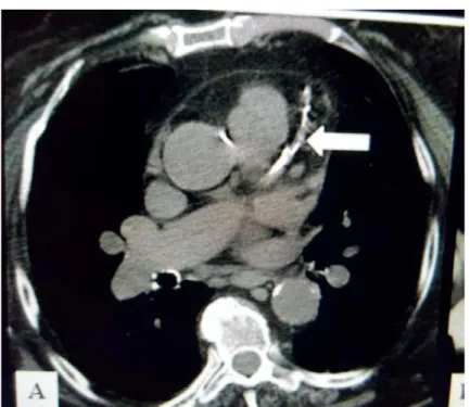 Figure 2 : Image du coroscanner illustrant des calcifications de l’artère IVA chez l’un de nos  patients 