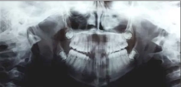 Figure 9 Orthopantomogramme montrant une fracture mandibulaire bifocale parasymphysaire  et branche horizontale gauches