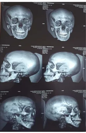 Figure 11 : TDM faciale avec reconstructions 3D : fracture de l’angle mandibulaire droit  