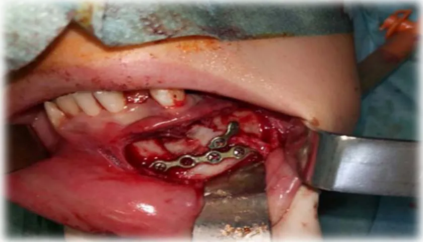 Figure 21 : Vue per opératoire endo buccale Ostéosynthèse la fracture  aux plaques  vissées 