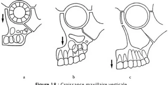 Figure  18 : Croissance maxillaire verticale. 