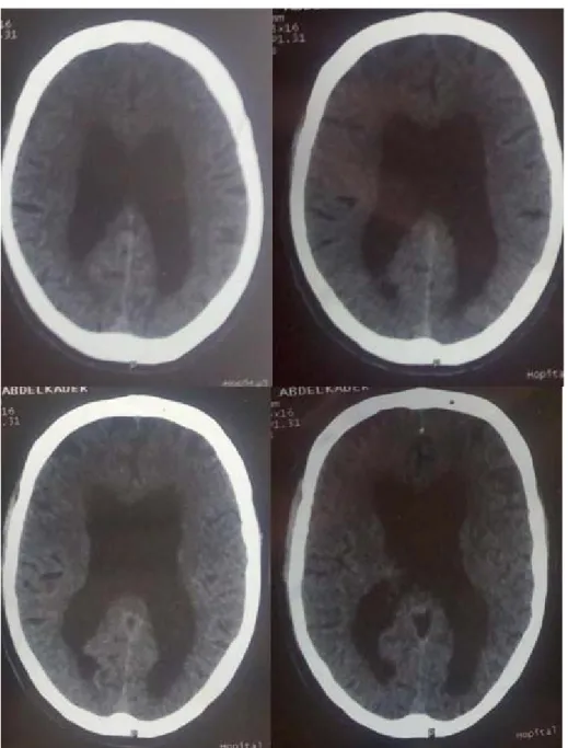 Figure 6 : TDM cérébrale en coupe axiale en fenêtre parenchymateuse sans injection de produit de  contraste montrant la présence d’une dilatation modérée des ventricules latéraux, sans obstacle 