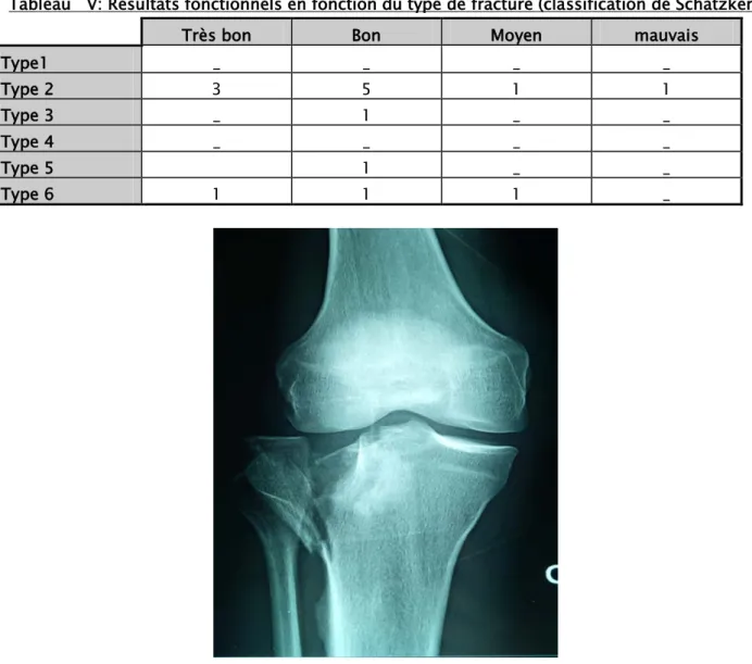 Tableau   V: Résultats fonctionnels en fonction du type de fracture (classification de Schatzker.) 