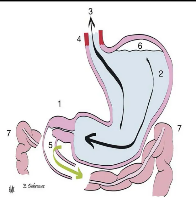 Figure 11 : physiopathologie de la sténose hypertrophique du pylore (49).  1. L’hypertrophie des fibres musculaires du pylore crée un obstacle sur le tube digestif ; 