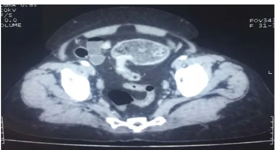 Figure 13 : Les données de la TDM abdominale chez nos patients 