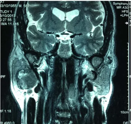 Figure 50.  IRM cervico-faciale, reconstruction coronale en séquence pondéré T2 montrant  tumeur parotidienne droite avec un hyposignal T2