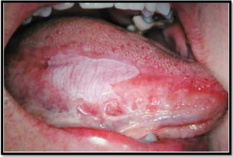 Figure 37 : Leucoplasie homogène du bord et de la face ventrale droits de la langue[34]
