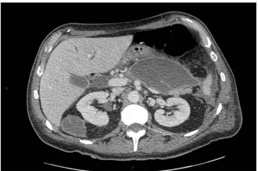 Figure  13: Classification Balthazar au TDM : Stade D : Une coulée de nécrose 