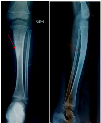 Figure 13: Radiographie de face + profil de la jambe montrant une image lytique entourée d’une  ostéocondensation