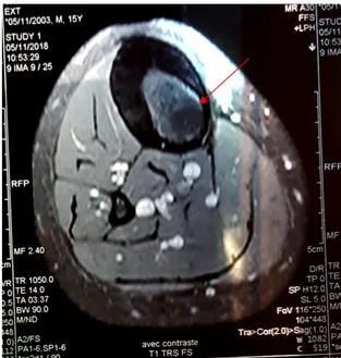 Figure 28: IRM coupe transversale  montrant une lésion en hyposignal  au niveau de la diaphyse  tibiale droite