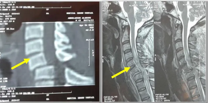 Figure 25 : TDM cervicale  et IRM  en reconstruction sagittale montrant une luxation C6-C7 avec  contusion médullaire étendue de C3 à D2 