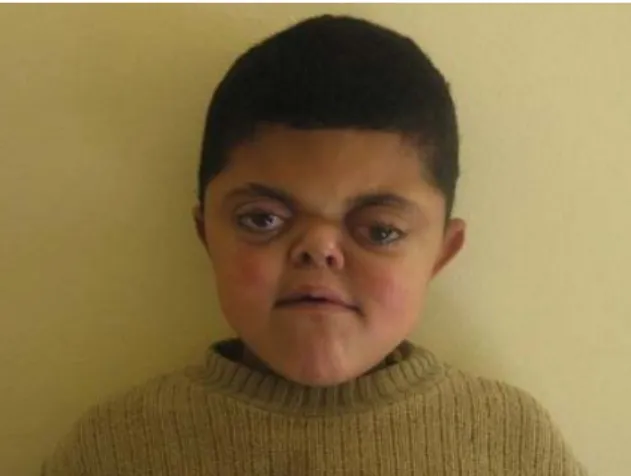 Figure 2 : Faciès typique d’un syndrome d’Apert [38] 