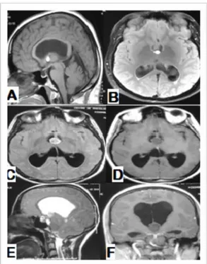 Figure 27: IRM encéphalique en coupe axiale BCD, sagittale A, E et coronale F, objectivant un  kyste colloïde du V3