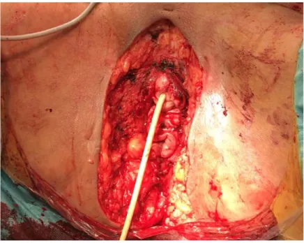 Figure 30 : vulvo-périnéectomie avant reconstruction cutanée par lambeau  en VY  