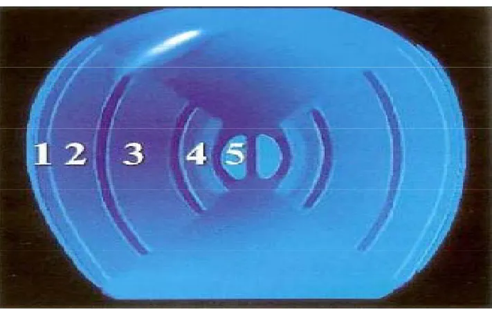 Figure 17 : Aspect bio microscopique des bandes de discontinuité du cristallin (5)  1- Capsule + épithélium ;  2- Cortex ;  3- Noyau adulte  4- Noyau foetal  5-Noyau embryonnaire  d