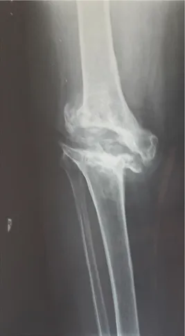 Figure 16 : radiographie face après ablation de la PTG initiale suite à un descellement septique 